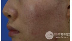 什么是果酸换肤?做过的来说一下吧~