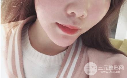 果酸换肤经历