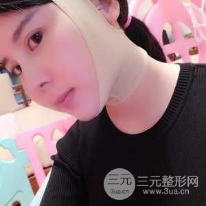 脸部吸脂减肥
