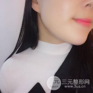 脸部吸脂减肥