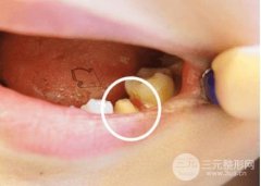 美容冠多少钱，过来人说下经验~