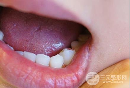 美容冠全瓷经验