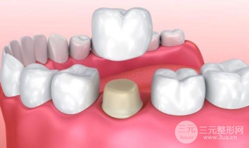 全瓷牙价格