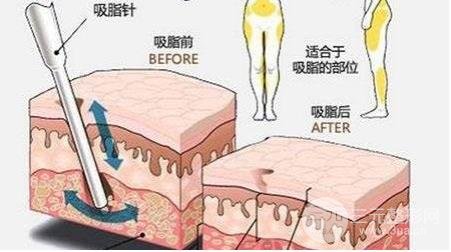大腿吸脂减肥部位