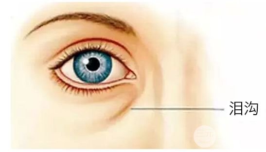 玻尿酸填泪沟可以维持多久?