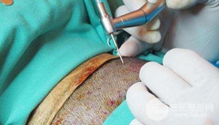 植发后遗症如何避免