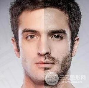 男士脸部脱毛