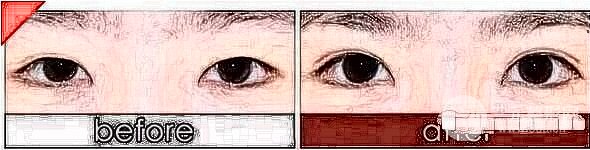双眼皮修复手术双眼皮消退