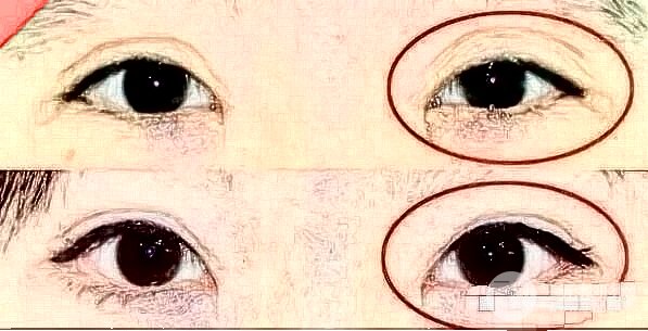 双眼皮修复手术双眼皮两侧不一样