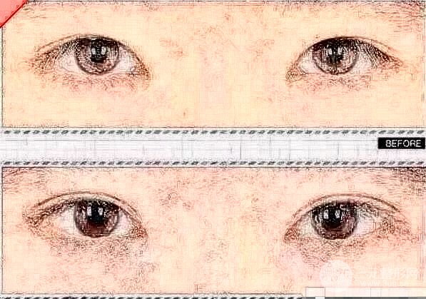 双眼皮修复手术伤疤明X