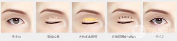 全切双眼皮手术示意图