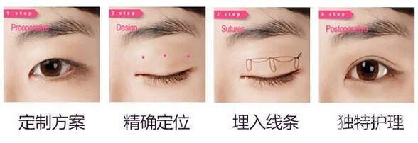 三点定位双眼皮手术示意图