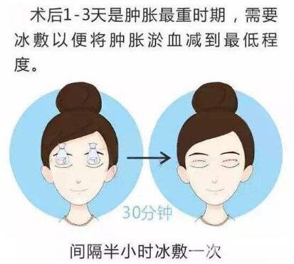 涮牛宫炎平手术后,48小时内可以用冰袋局部性冰敷