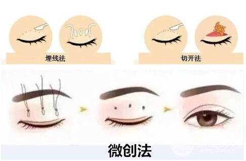 微创双眼皮