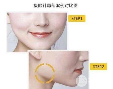 注射瘦脸品牌
