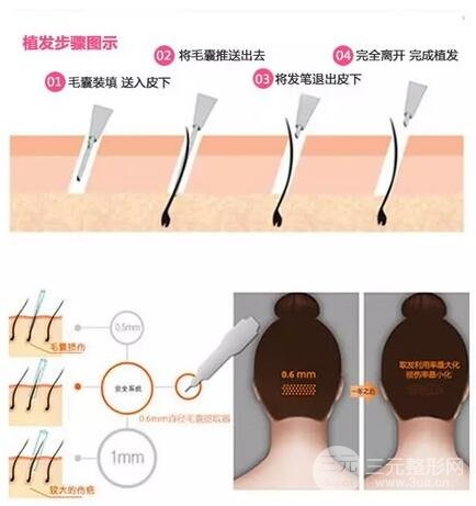 重庆毛发移植