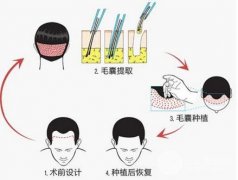 种植毛发多钱 千万不要在踩坑 种植毛发多钱 千万不要在踩坑