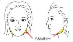 女人过大下颌角整形要怎么做 落实V脸不是梦
