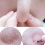 毛孔粗有黑头怎么办 科普篇