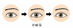 什么人适合开眼角 眼角开的越大越好吗 科普篇