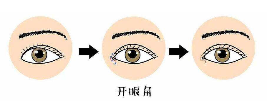 适合开眼角