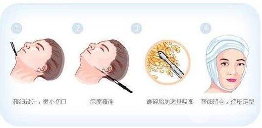 面部吸脂费用