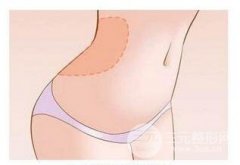 吸脂塑身是个技术活 科普篇