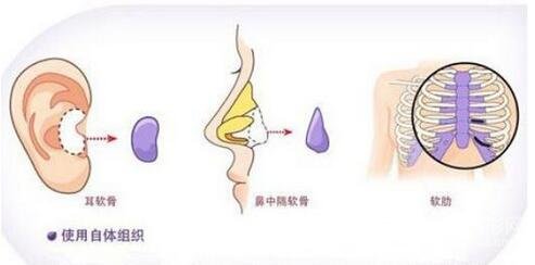耳软骨垫鼻尖