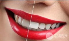 全瓷牙价格是多少 精彩分解