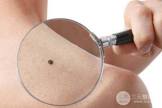 黑痣怎么去除