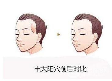 注射玻尿酸丰太阳穴