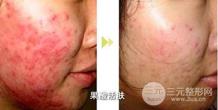 果酸换肤后注意事项