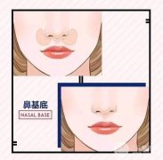 成都垫鼻基底一般要多少钱 价格详解篇 成都垫鼻基底一般要多少钱 价格详解篇