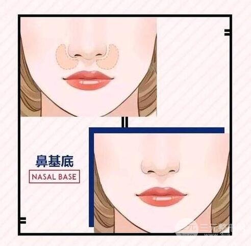 垫鼻基底