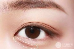 脂肪填充卧蚕的果好不好?够自然吗? 脂肪填充卧蚕的果好不好?够自然吗?