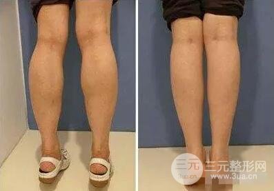 瘦小腿手术