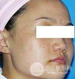 复合彩光祛痘果