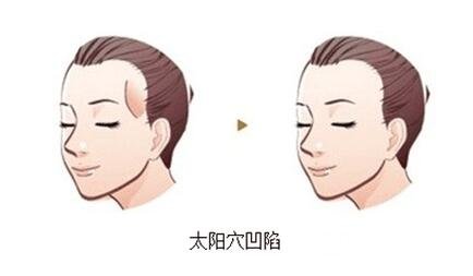 太阳穴凹陷