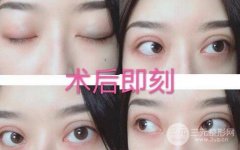日式微创双眼皮是埋线吗 这些真相你知晓几个？