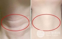 消除颈纹直接的方法 看看你合适哪种