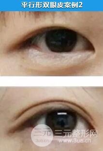 开扇双眼皮