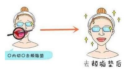 去颊脂垫价格