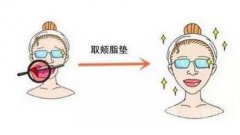 去颊脂垫果多久出来 需要注意神马