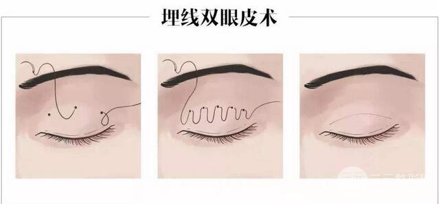双眼皮埋线