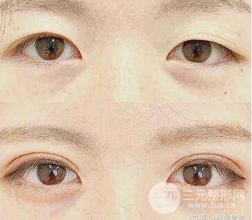 双眼皮埋线
