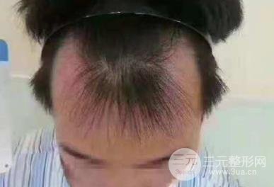 成都碧莲盛男性植发案例