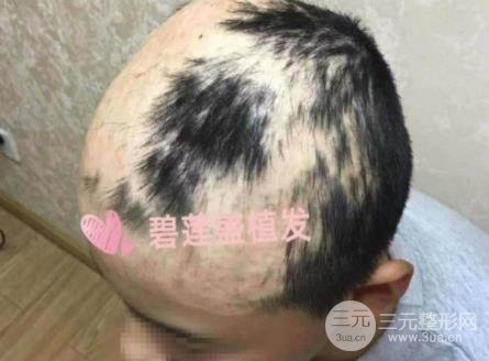 成都碧莲盛疤痕植发案例