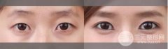 整双眼皮的坏处真的有么 Duang~科普篇