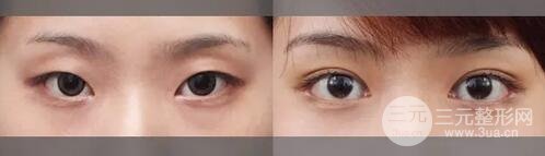 整双眼皮的坏处