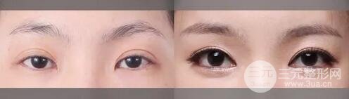 整双眼皮的坏处